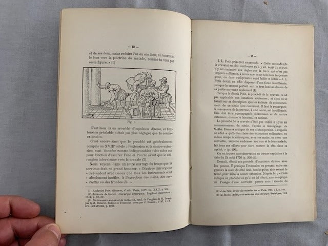 Antoine Voreux : Du Procédé de la Cravate dans les Luxations Anciennes de l'Épaule