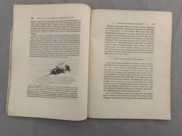 M. Debout : Quelques considérations sur la Paralysie Traumatique localisée  note lue à la Société de Chirurgie