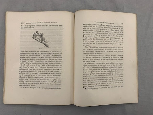 M. Debout : Quelques considérations sur la Paralysie Traumatique localisée  note lue à la Société de Chirurgie